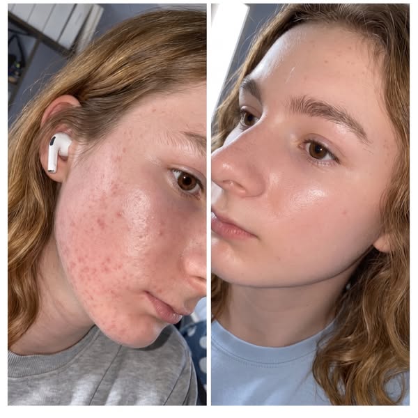 It's an absolute nightmare for everyone with acne!