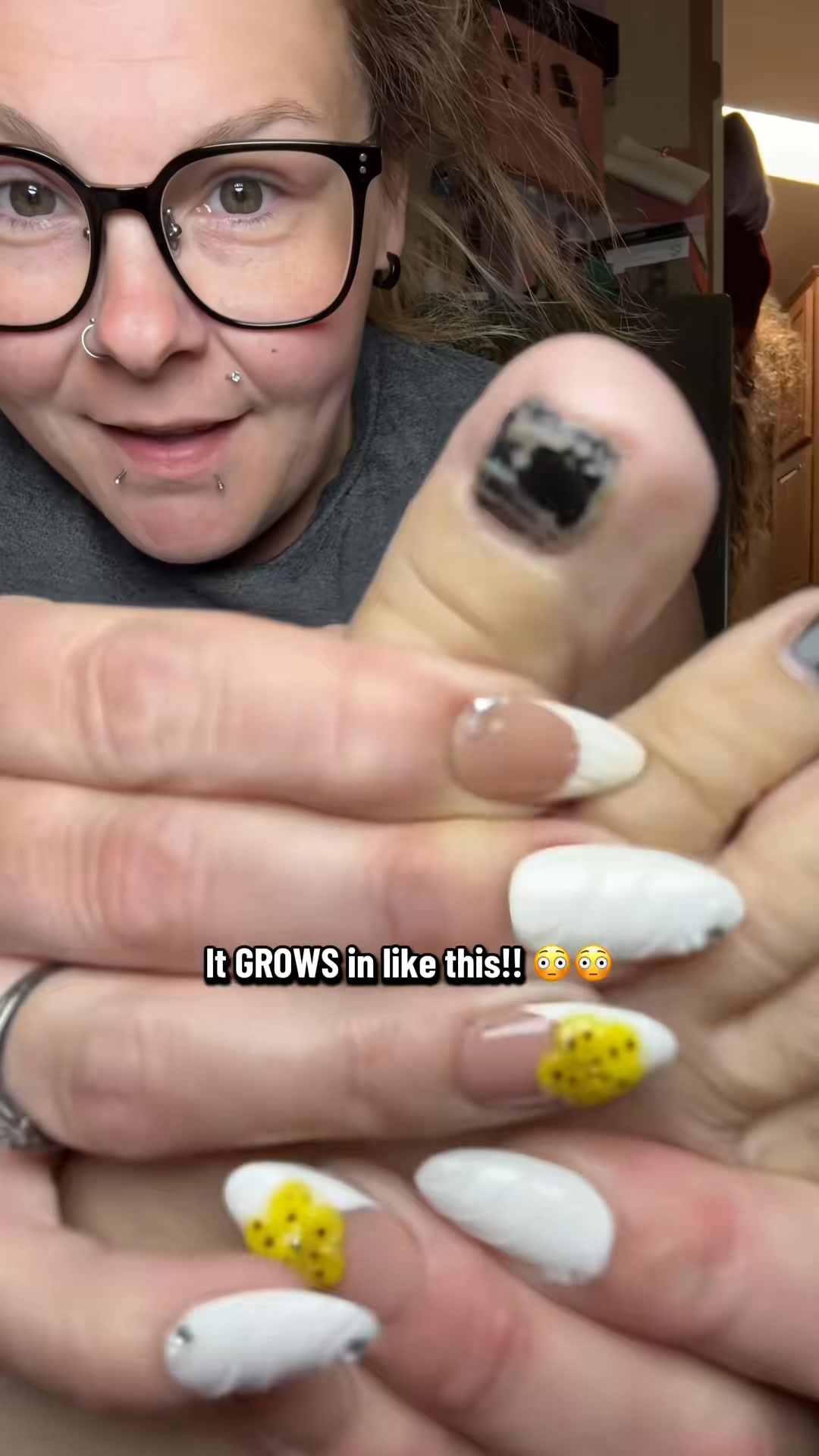 How to Actually Cure Foot Fungus