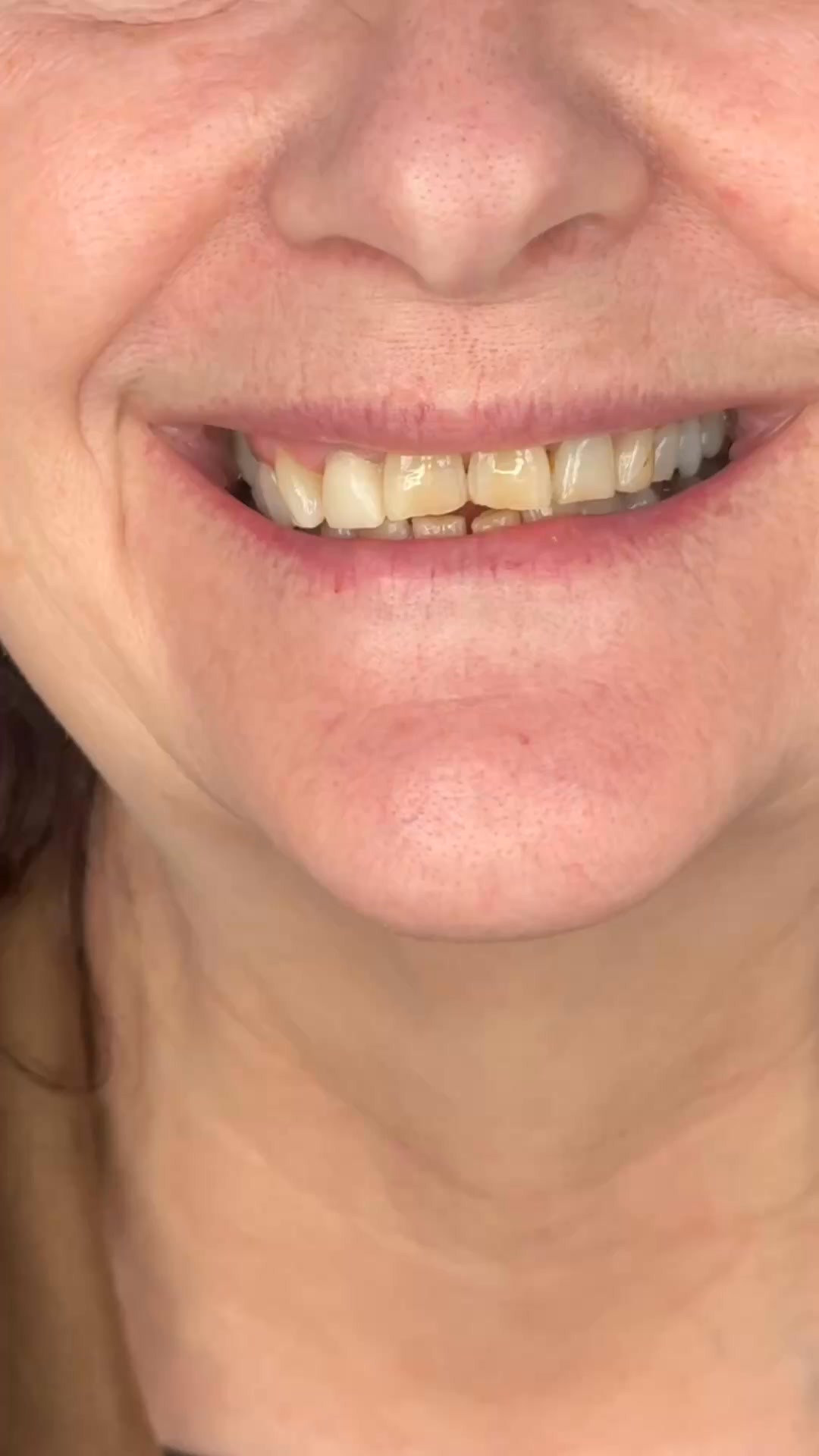 Your Smile, Just 10 Years Younger. Without Anyone Knowing You Had Work Done.