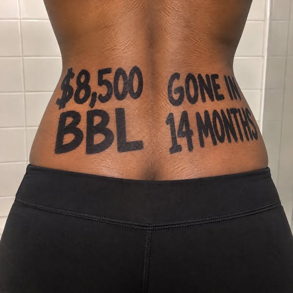 What a recovery nurse sees 18 months after a BBL