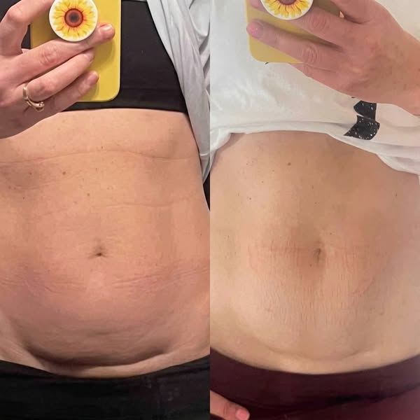 Why your c-section shlef won't leave.