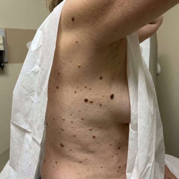 If You Have Rough, Raised Spots That Keep Multiplying, Read This
