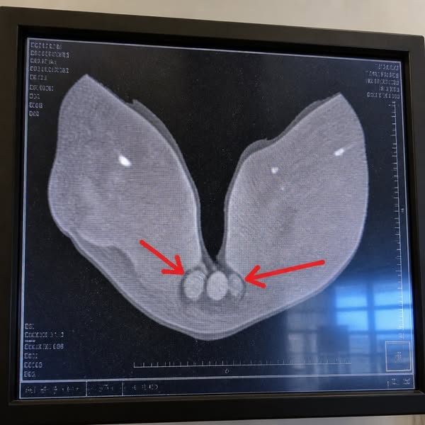 Hemorrhoids Are Collagen Failure?
