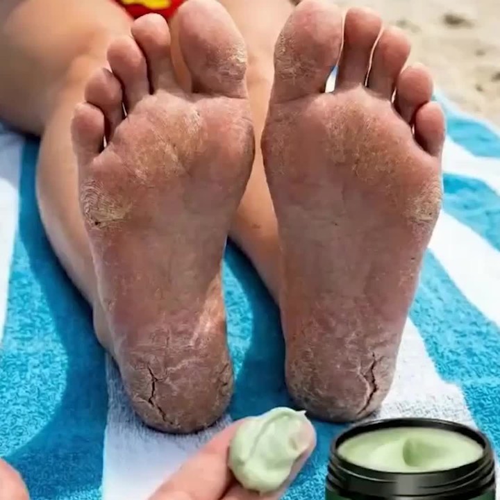Crème pour les pieds à l’huile d’arbre à thé
