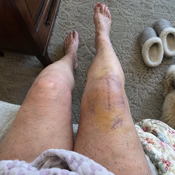 Read If Knee Pain After Replacement
