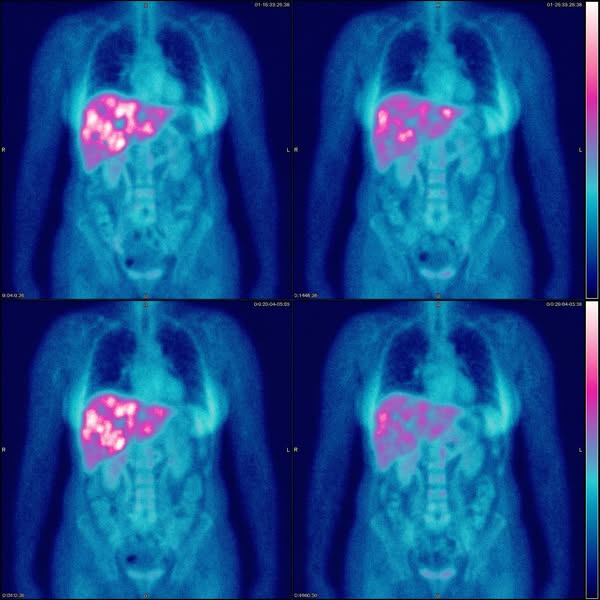 What 200 fatty liver patients on milk thistle actually showed me...