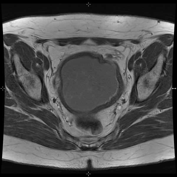 I Watched My Wife's UTIs Change Our Life. The Real Cause Wasn't Bacteria.
