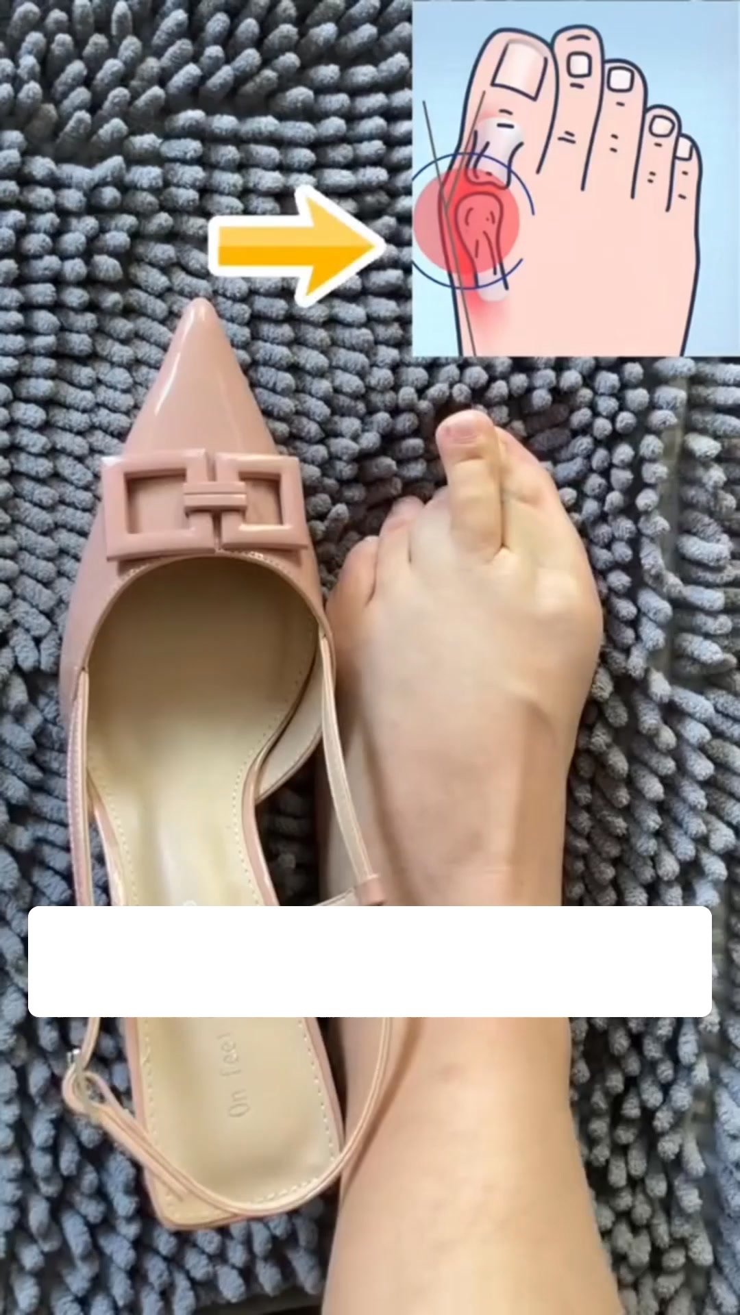 Taśma korygująca Hallux Valgus