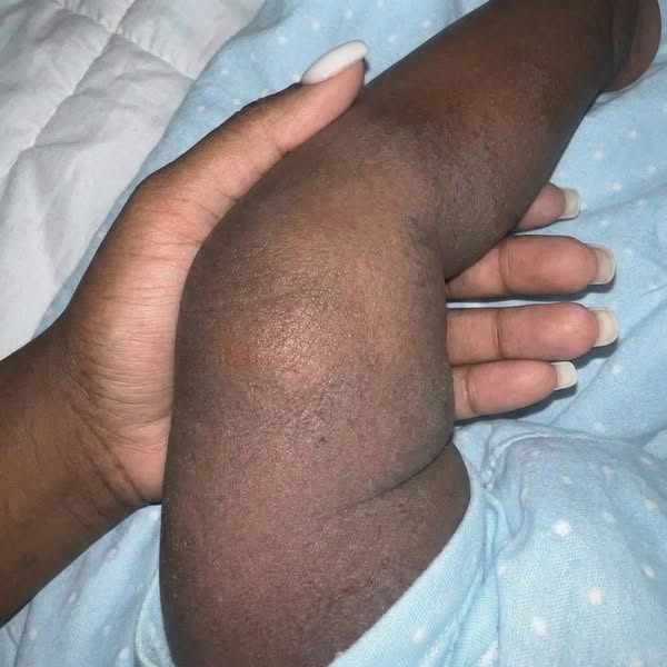 Read this if your baby has eczema