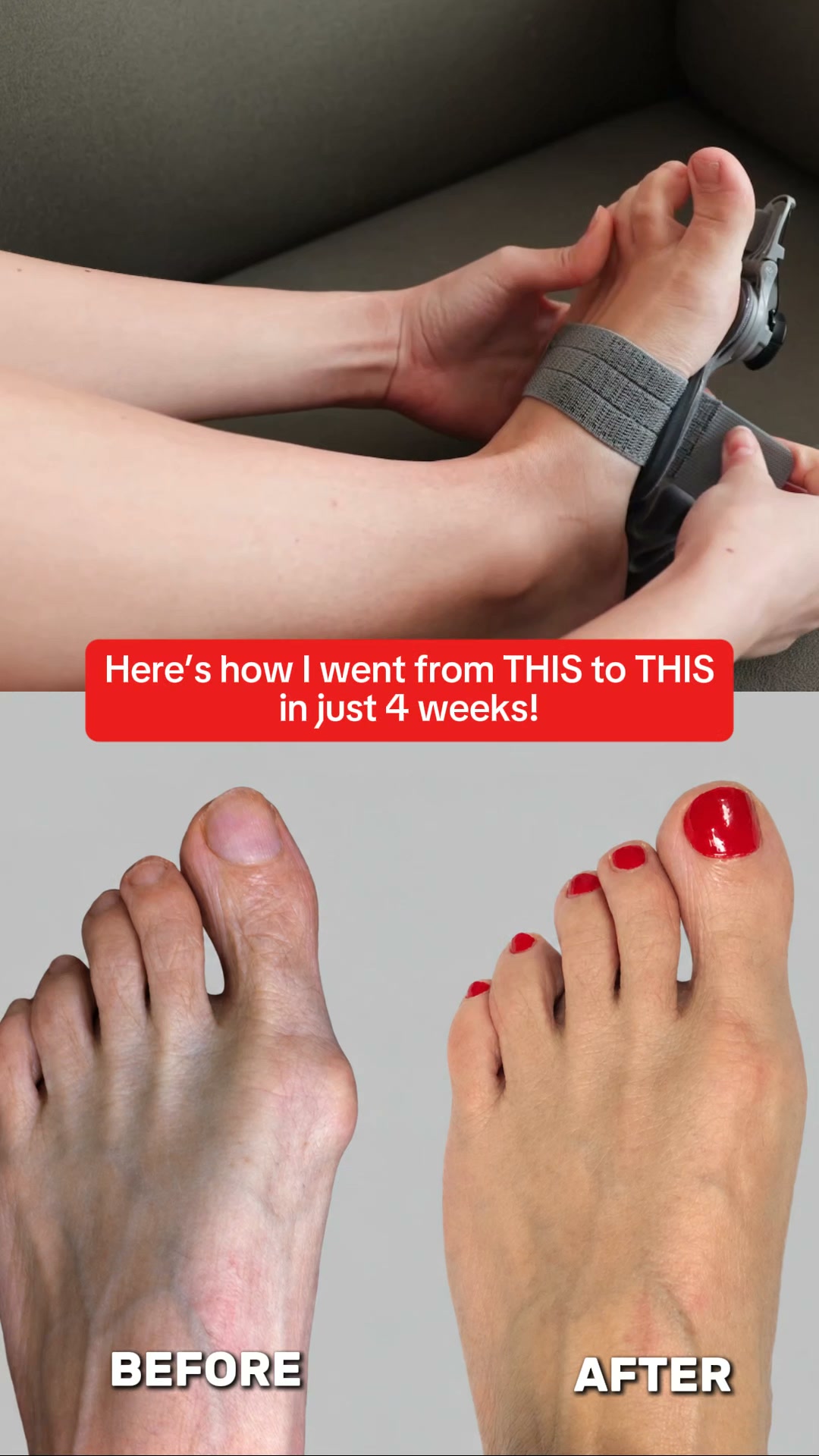 Fix Your Bunions Without Surgery