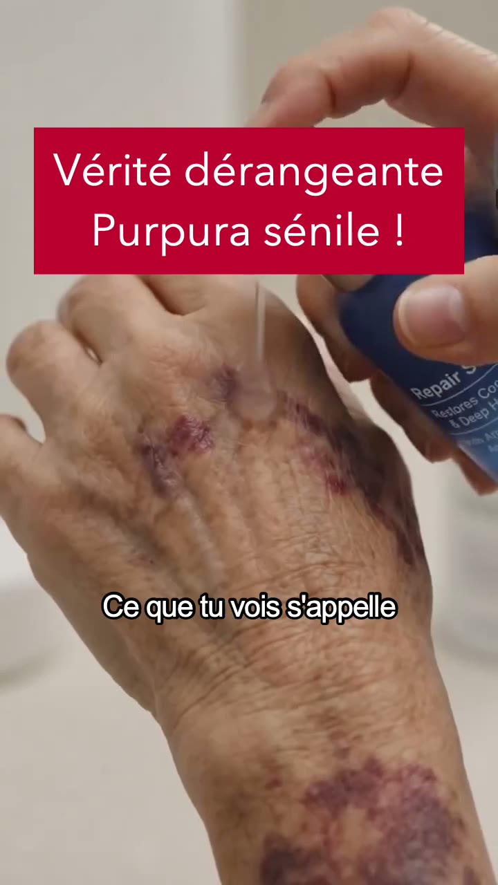 Stop aux bleus au moindre choc