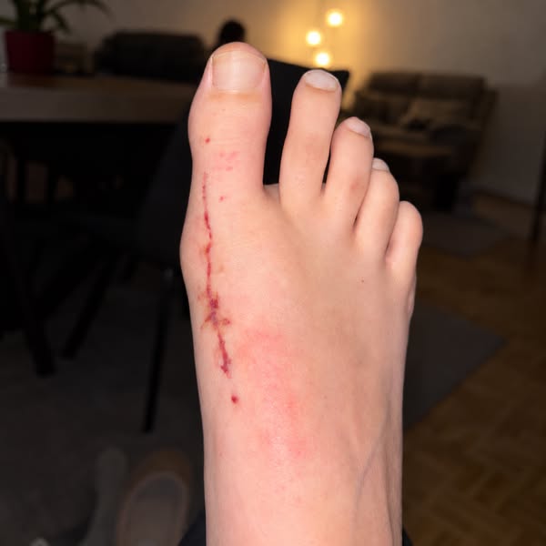 Lis ça si ton gros orteil dévie.