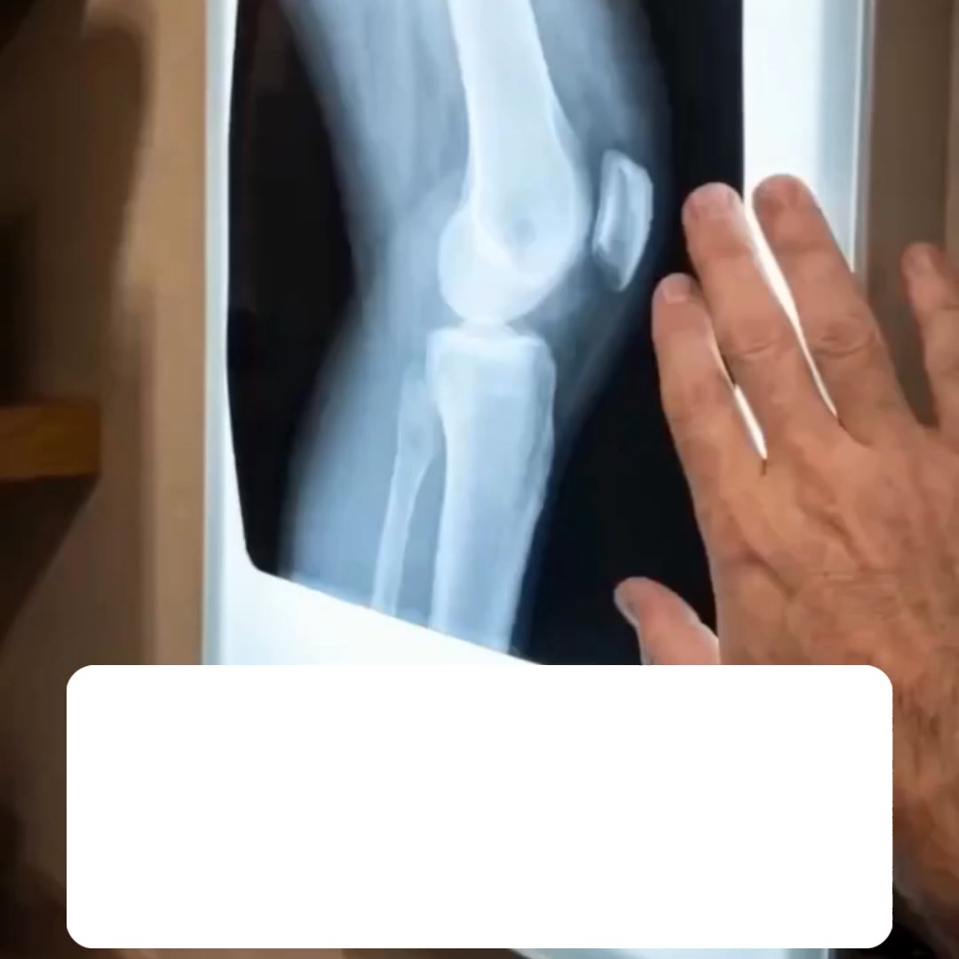 Kniebrace Air: Gerichte ondersteuning op precies de plek waar de knie het begeeft