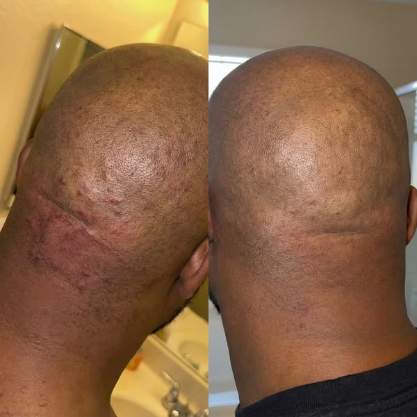 Dealing With Razor Bumps? Read This