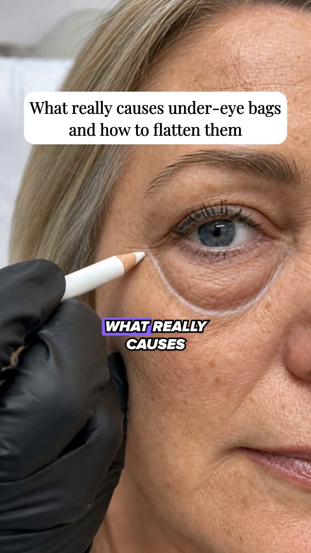 What really causes under-eye bags after 50