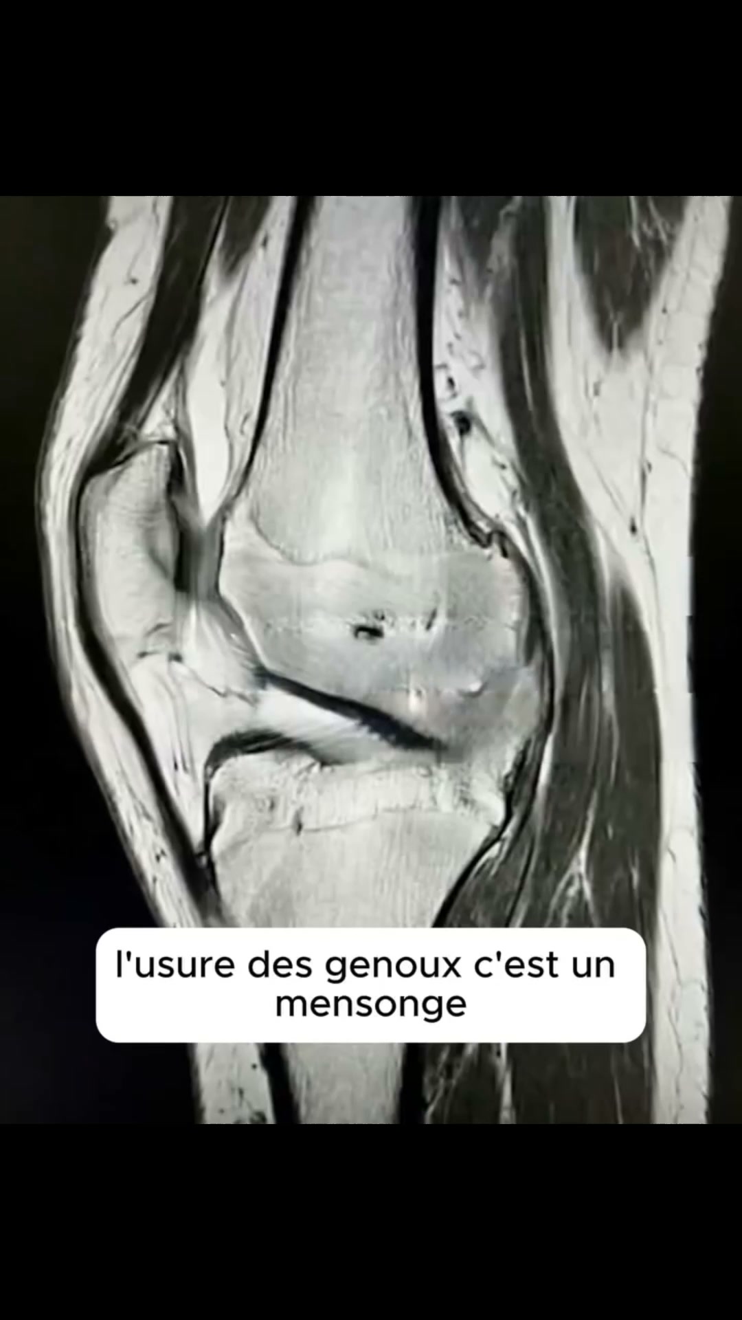 Douleurs au genou ou arthrose ?