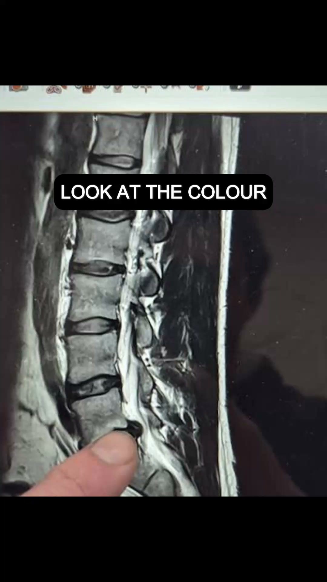 The bulge is the symptom. The colour is the cause