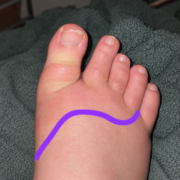 Nearly Half Have Bone Erosion