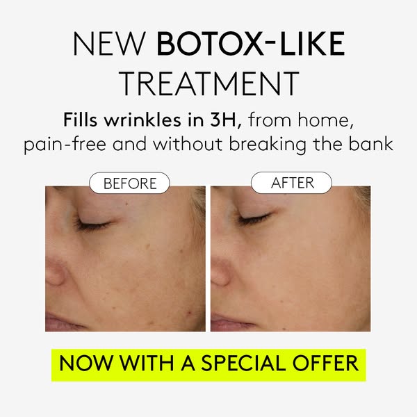 Girl, have you seen these results for wrinkles?