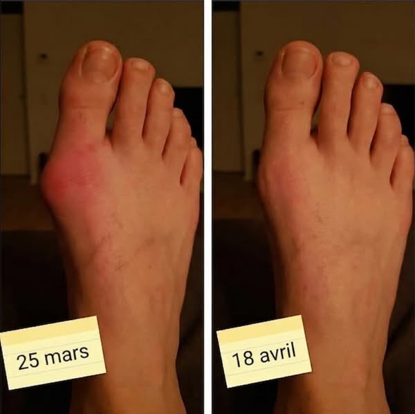 Si vous souffrez d'oignon et que vous pensez que