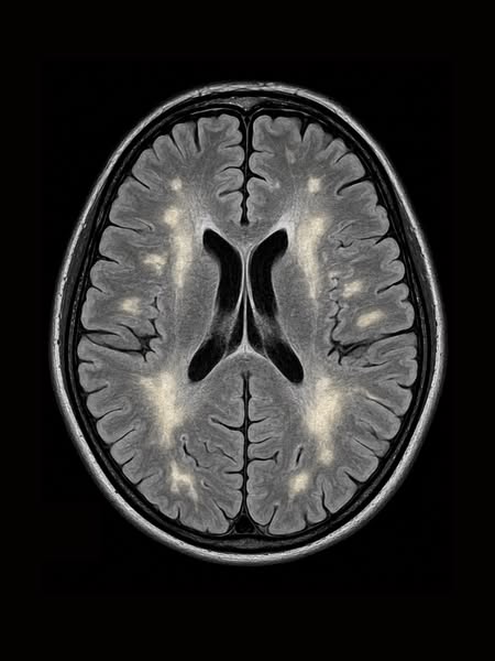 Un neuropsychologue explique ce qui aggrave vraiment le TDAH
