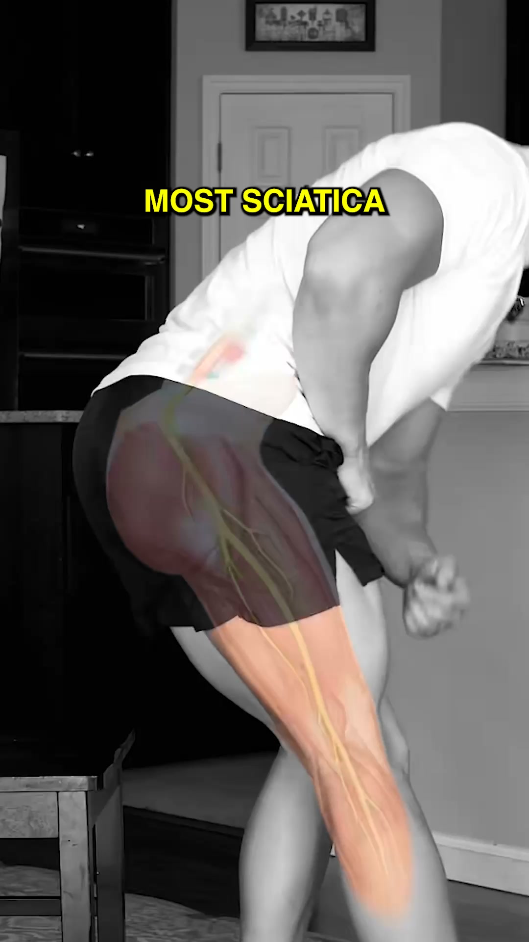 Sciatica Stole 3 Years Of My Life. This Stops The Progression Overnight While You Sleep