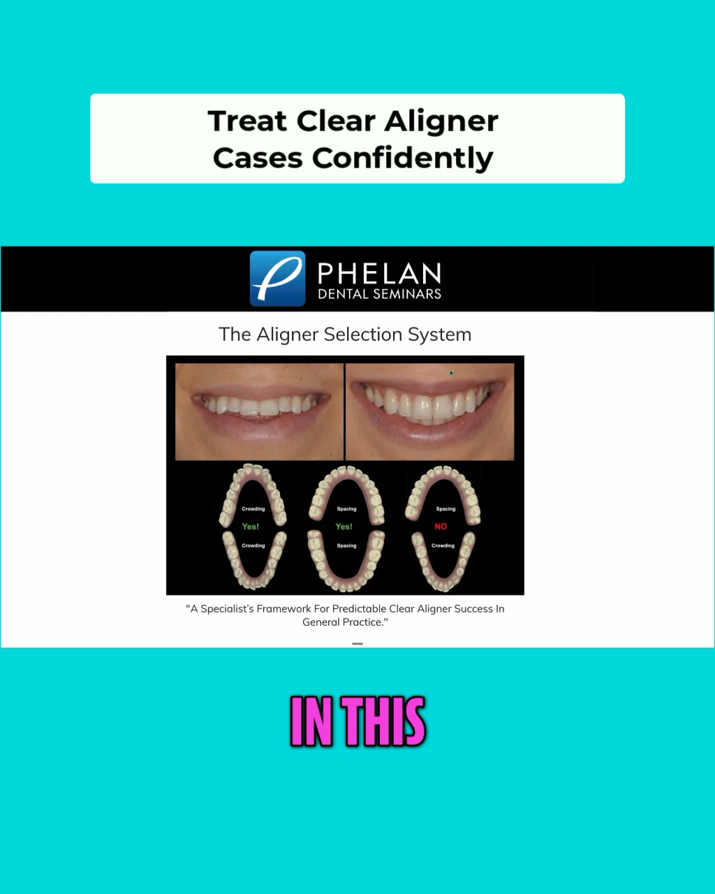 The Aligner Selection System