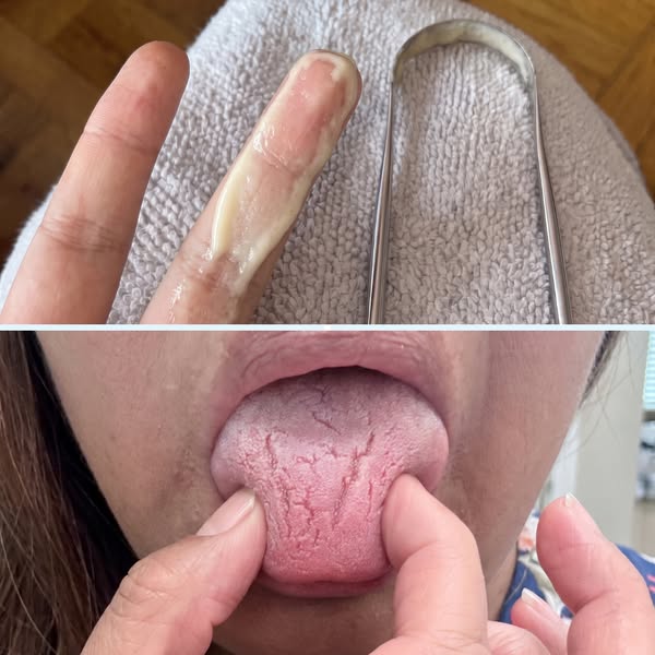 Avoiding Kisses Because of Zepbound Breath? It’s Not Your Hygiene