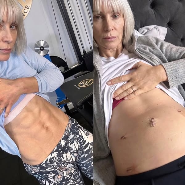 If prolapse repair is already on your calendar, read this
