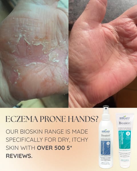 Sick of red sore hands that crack at everything?
