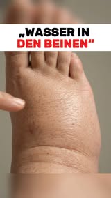 Schwellungen natürlich lindern