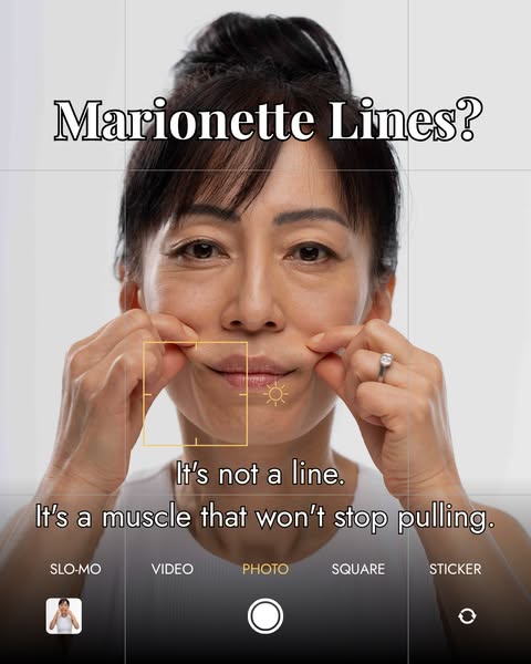 Marionette Lines: The Fix No Cream Can Deliver