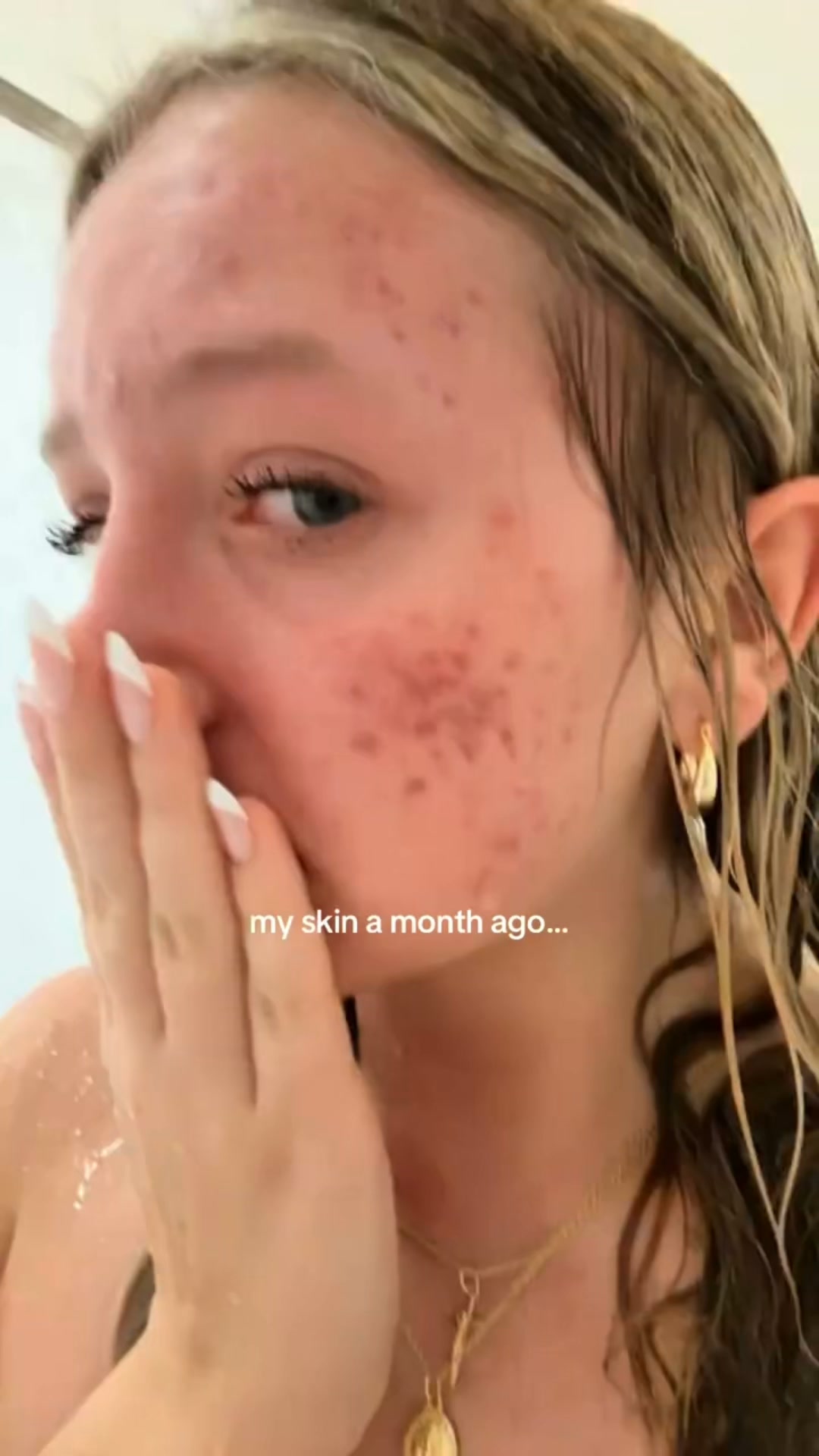 The Korean Answer To Acne’s Aftermath