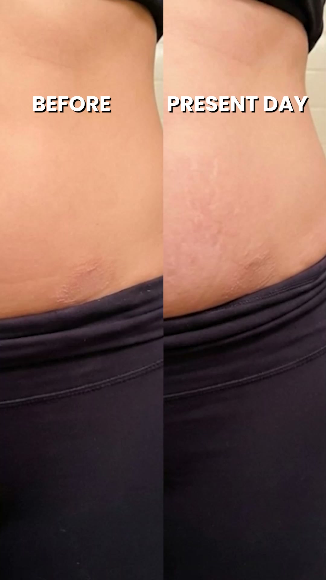 Why the rash under your belly won not go away on its own