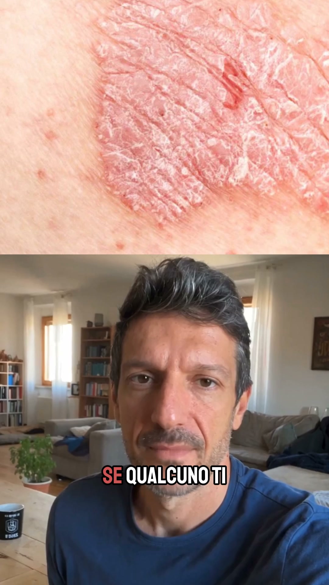 Supporto naturale per tua Psoriasi