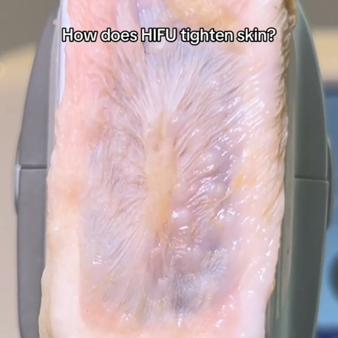 Aprende HIFU 360° Desde Cero