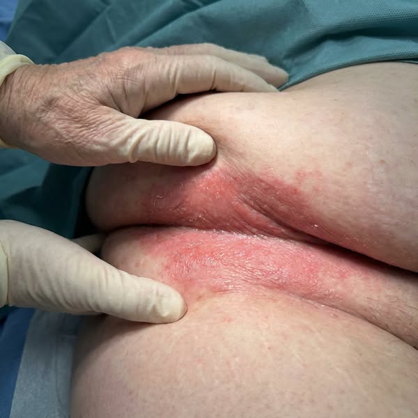 A Fungal Infection Isn't The Reason The Rash Keeps Coming Back!