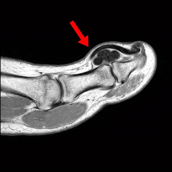 Why Nothing Works For Toenail Fungus
