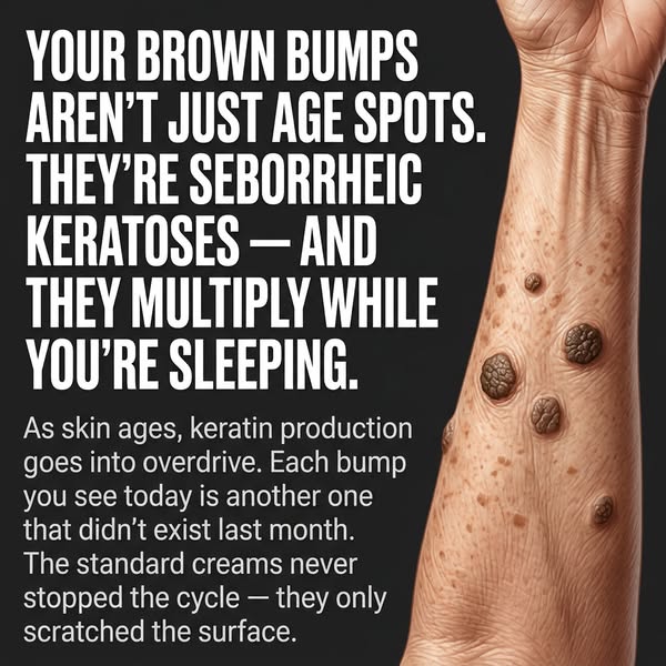 Made for Skin That Keeps Producing Seborrheic Keratoses