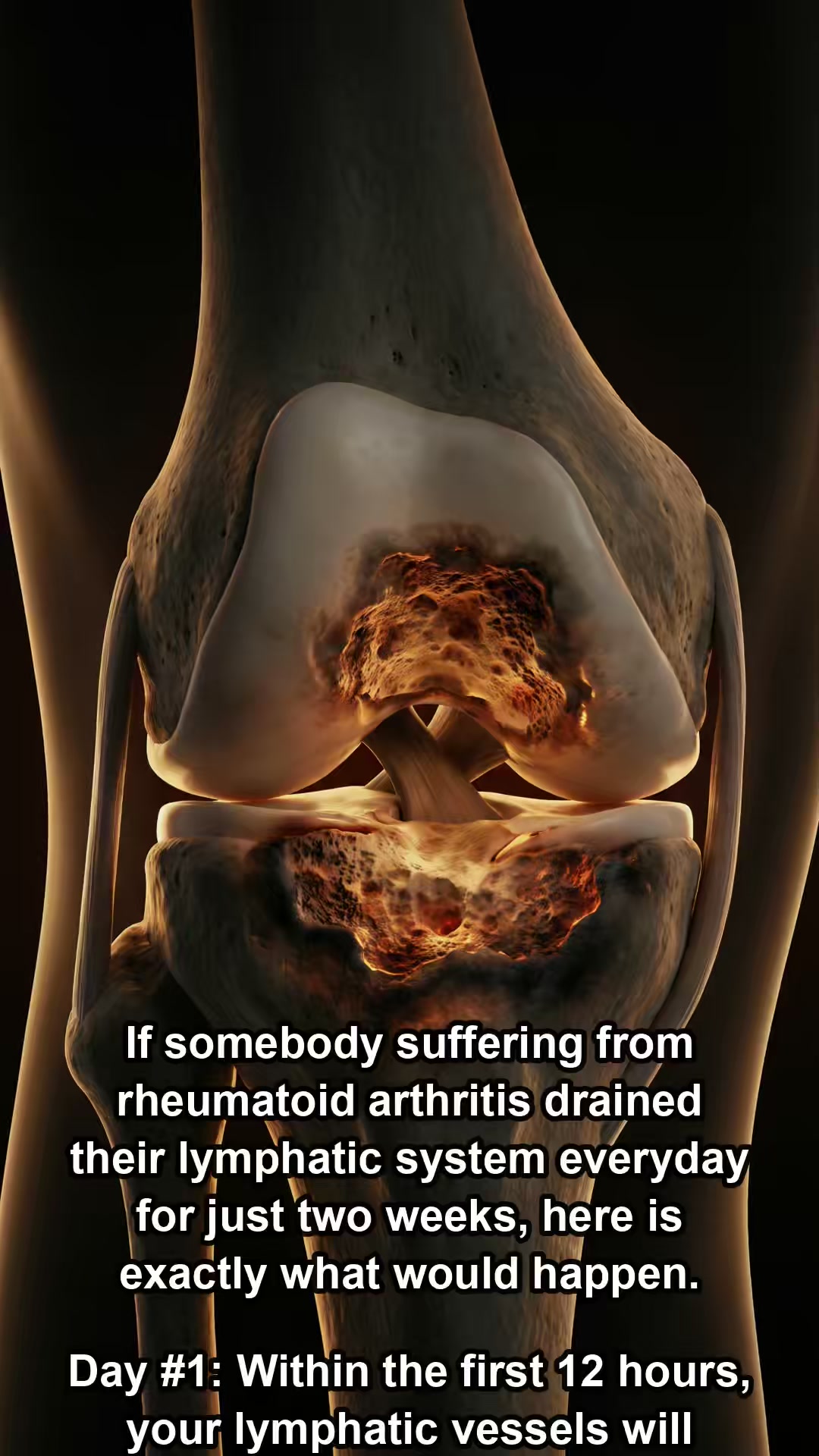 Rheumatoid Arthritis?