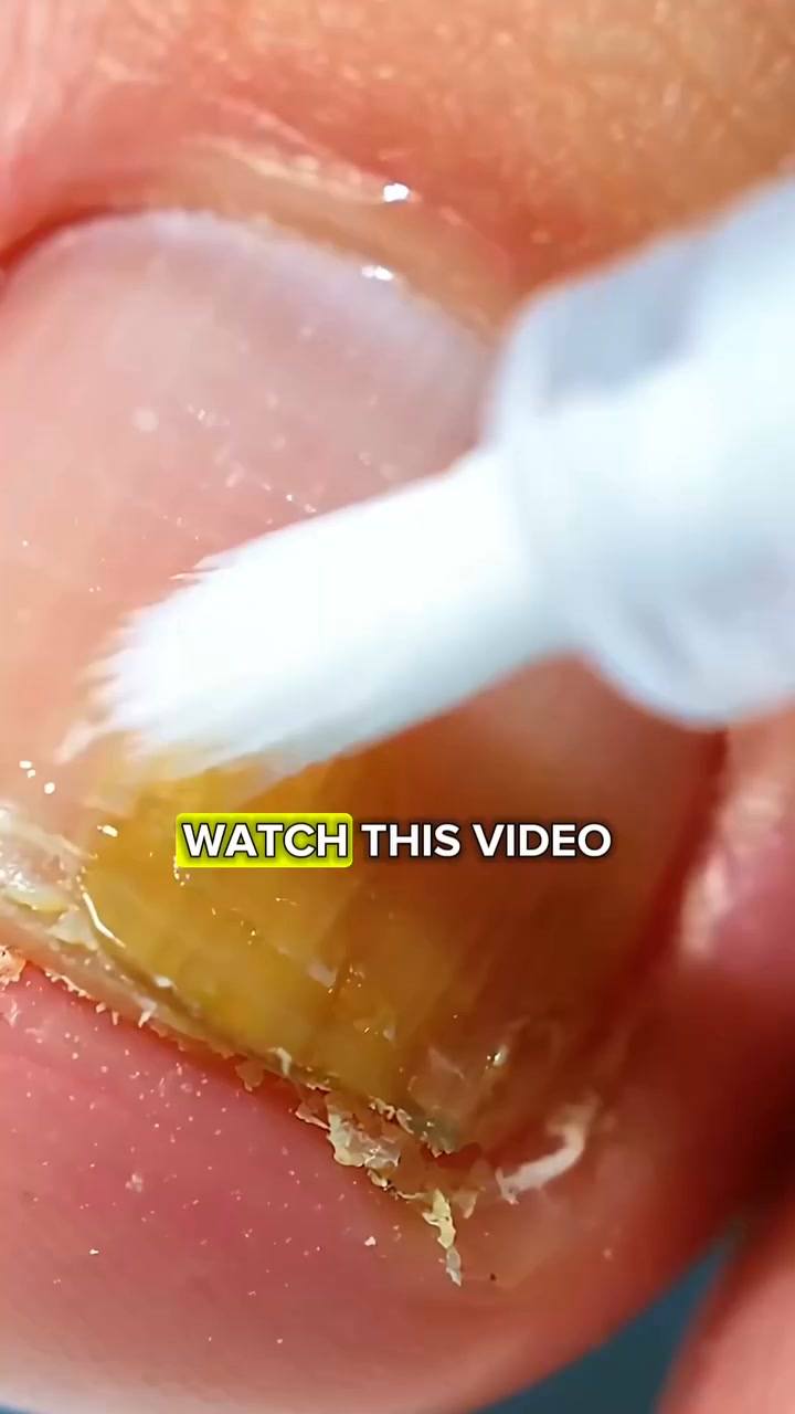 The Fastest Way To Get Rid Of Nail Fungus