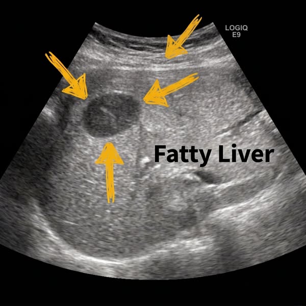 To men who've been told fatty liver isn't a big deal