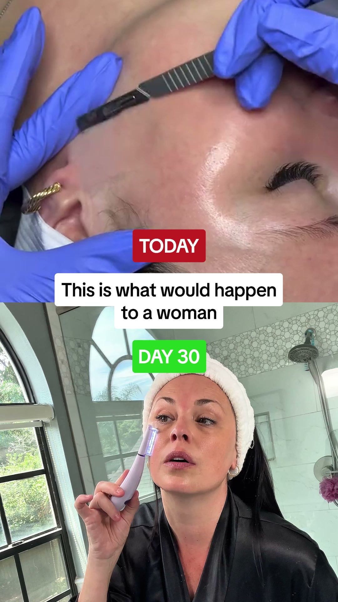 Dermaplaning, Made Effortless