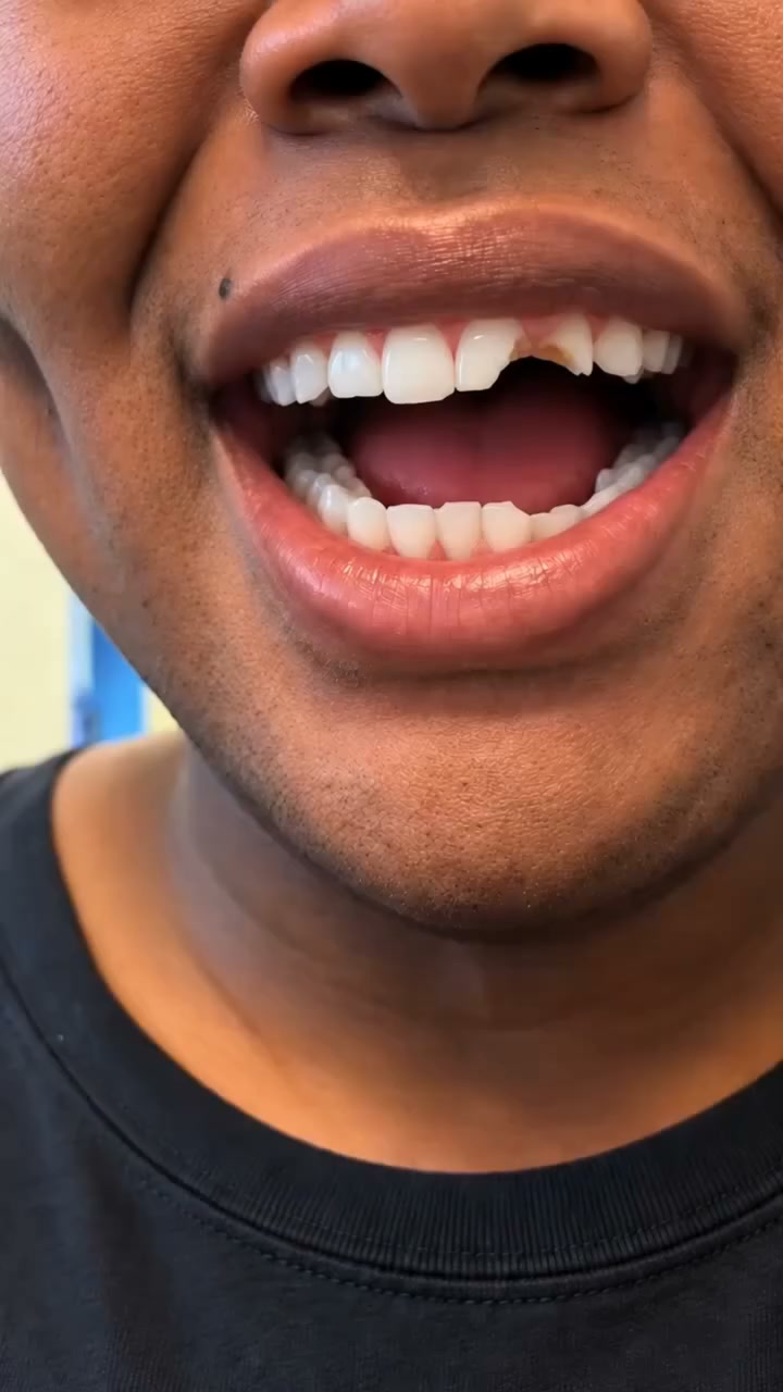 See visible structural filling and natural enamel restoration in just 5 days — rebuild weakened enamel, eliminate pain, and flash your br