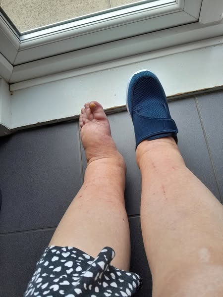 YEARS of hiding your legs in 2 days?