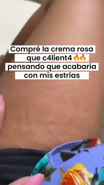 Estrías Menos Visibles