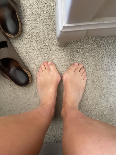 My Mum Cancelled Her Bunion Surgery Three Days Before