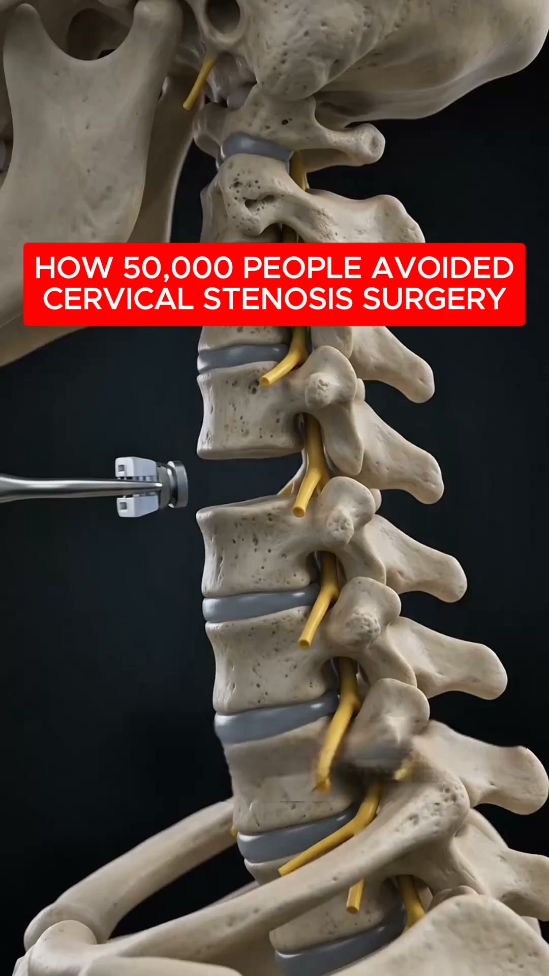 The Overlooked Muscle Behind Cervical Stenosis