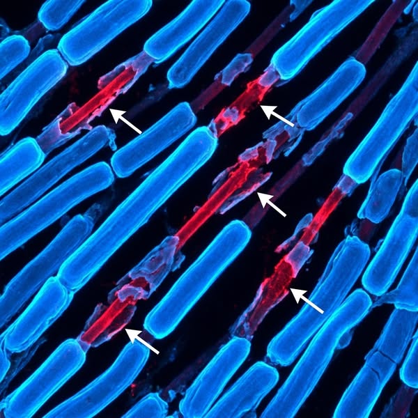 If you have neuropathy, read this