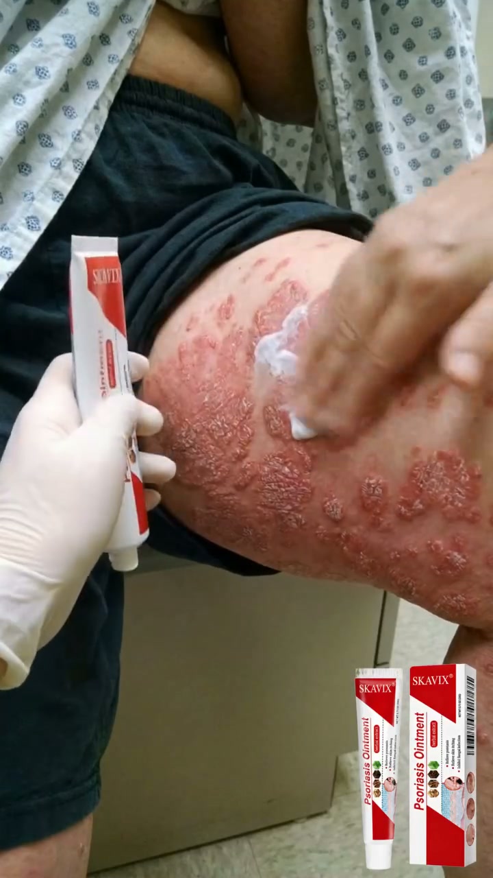 Richer Care for Dry, Flaky Skin